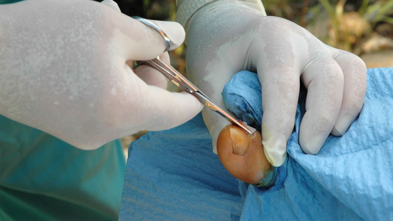 Nail surgery being performed under sterile conditions